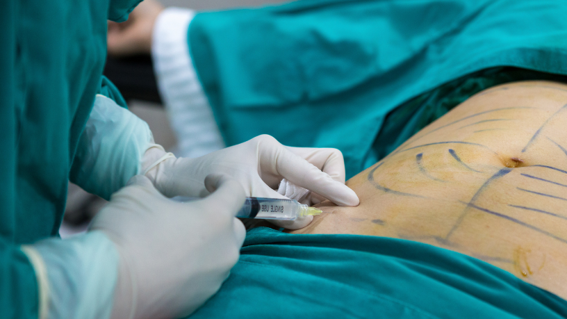 Entenda com Dr. Haeckel Cabral a diferença entre remover gordura e redistribuí-la com estratégia na lipoescultura.
